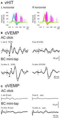 Vestibular-Evoked Myogenic Potentials in Bilateral Vestibulopathy